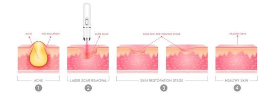 tratamiento con láser vascular de la cicatriz del acné. inflamación asociada con las espinillas. la estructura de la cicatriz del acné de la piel. concepto de cuidado de la piel de belleza médica. Ilustración vectorial 3d. vector