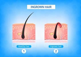 Ingrown hair. Hair has grown back into the skin surface after shaving. Formation of skin acne or pimple. Anatomy infographics of hair and skin. 3D vector illustration.