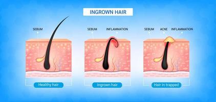 Ingrown hair. Hair has grown back into the skin surface after shaving. Formation of skin acne or pimple. Anatomy infographics of hair and skin. 3D vector illustration.