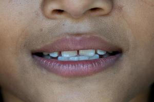 bebé sonrisa cerca. dientes blancos de un niño aislado en un fondo blanco foto