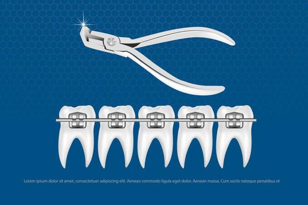 3d vector illustration, realistic teeth with braces upper and lower jaw. Alignment of the bite of teeth, dentition with braces, dental braces.