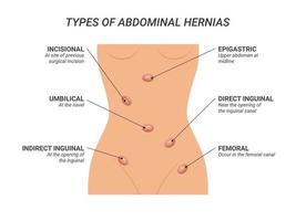 Types of abdominal hernias illustration on isolated background vector