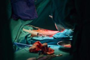 Surgery for Coronary Artery Bypass photo