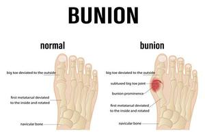 osteoarthritis, rheumatoid arthritis and post-traumatic arthritis. comparison of the human foot with common forms of arthritis. inflamed synovium and joint deformity. vector