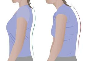 ilustración de la espalda de una mujer con una columna sana y con escoliosis, una columna doblada. vector. vector