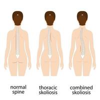 Spine deformation types and healthy spine comparison diagram poster with backbone curvatures. Female profile and back view. Chiropractic information. vector