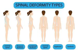 Tipos de deformación de la columna vertebral y afiche de diagrama de comparación de la columna vertebral saludable con curvaturas de la columna vertebral. perfil femenino y vista posterior. información quiropráctica. vector