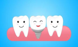 Dental implant and normal tooth. Tooth implant screw in gum vector