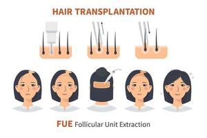 Stages of woman hair transplantation FUE Follicular Unit Extraction. Treatment of baldness, alopecia and hair loss. Vector medical infographics, a female head scalp. Strip, graft machine.