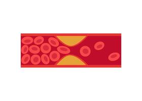 Deep vein thrombosis, artery and vein disease with fat cells, abnormally of blood vascular flow. Cholesterol in blocked in human blood vessel. Vector illustration