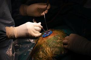 vista del neurocirujano que realiza una cirugía cerebral foto