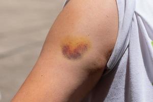 Bruise on a woman right arm photo