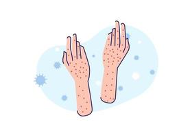 Síntomas de viruela del mono o viruela del mono vector de ilustración plana aislado. pecas en las manos debido a los síntomas de la viruela del mono.
