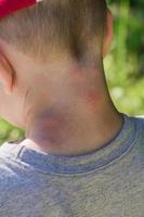 picadura de mosquito. cuello de un niño pequeño con piel roja después de picaduras de insectos al aire libre. reacción alérgica foto