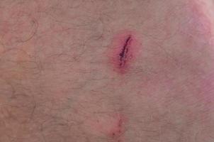 scratch on man's leg. wound on the skin. photo