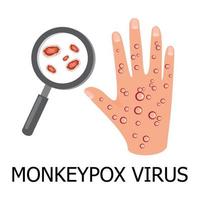 Monkeypox virus concept illustration. Hand with rash from monkeypox virus. Magnifier with virus cells. Medical concept. vector