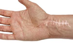 Scar with stitches on the wrist after surgery. Fracture of the bones of the hands in fist isolated on white background photo