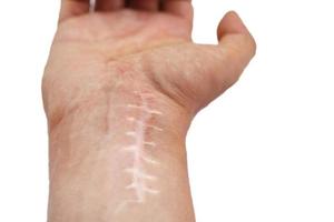 Scar with stitches on the wrist after surgery. Fracture of the bones of the hands in fist isolated on white background photo