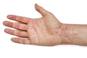 Scar with stitches on the wrist after surgery. Fracture of the bones of the hands isolated on white background photo