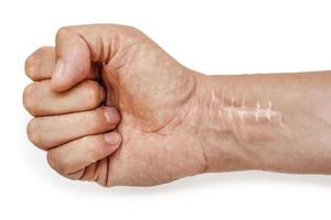 Scar with stitches on the wrist after surgery. Fracture of the bones of the hands in fist isolated on white background photo