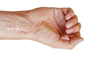 Scar with stitches on the wrist after surgery. Fracture of the bones of the hands in fist isolated on white background photo