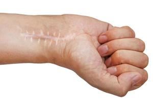 Scar with stitches on the wrist after surgery. Fracture of the bones of the hands in fist isolated on white background photo