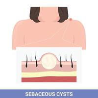 Illustration of Cyst on shoulder that cause swelling and inflammation vector