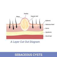 Sebaceous Cyst or other skin and follicle problems illustration vector