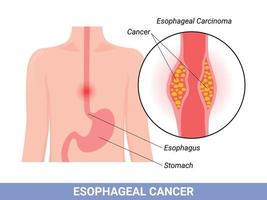 Medical illustration of the symptoms of esophageal carcinoma vector