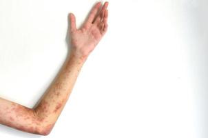 El tratamiento para la dermatitis atópica, una infección y picazón en el brazo de una niña, implica administrar medicamentos. foto