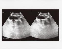 full abdomen ultrasound sonogram photo