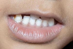 bebé sonrisa cerca. dientes blancos de un niño aislado foto