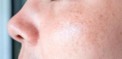 Sunburn on the face of an Asian woman,wrinkles, dark spots, freckles, on face middle age woman. closeup photo, blurred.,Problem skincare and health concept. photo