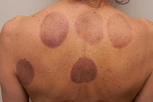 una mujer que se sometió a una terapia con ventosas en la espalda para el dolor foto