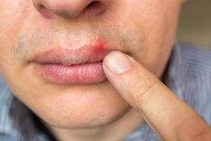 red inflammation and herpes zoster virus on upper male lip photo