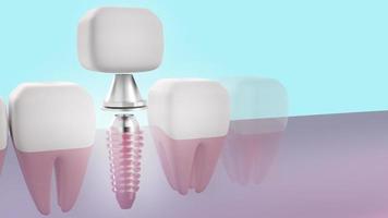 imagen de renderizado 3d de implante dental para contenido médico. foto