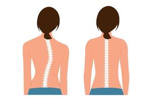 Good posture and bad posture. Chiropractic before after image. Scoliosis.Woman's body and backbone. vector