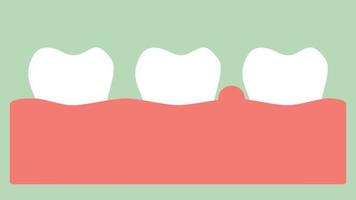 Gingivitis oder Zahnfleischerkrankungen, Zahnfleischentzündungen vor Parodontalerkrankungen - zahnärztlicher Cartoon-Vektor im flachen Stil rendert 2D-Filmmaterial-Animation, im 4k- und uhd-Ultra-High-Definition-Videoformat 3840x2160 video
