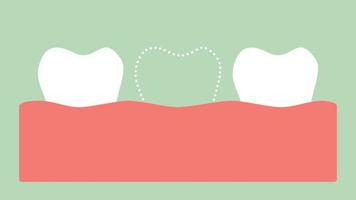 saknad tand, utrymme i munnen - dental tecknad vektor platt stil rendering 2d-filmanimation, i 4k och uhd ultrahögupplöst videoformat 3840x2160 video