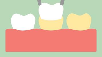 sbiancamento dei denti da faccette, dente da giallo a bianco - stile piatto di vettore del fumetto dentale rende l'animazione di metraggio 2d, in formato video ad altissima definizione 4k e uhd 3840x2160