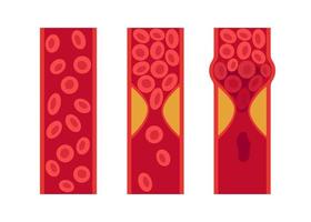 Normal and cholesterol-blocked artery. Blood clot, thrombus, atherosclerotic plaque. Deep vein thrombosis DVT or arterial clot, blood vascular flow. Blocked circulation in blood vessel. Vector