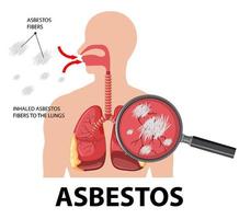 Diagram showing asbestosis in lungs vector