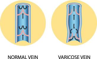 una comparación de vena normal con vena varicosa vector