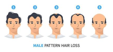 etapas de pérdida de cabello, patrón masculino de alopecia androgenética. pasos de infografía vectorial de calvicie en un estilo plano con un hombre. millas por hora vector