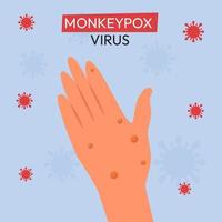 Monkeypox outbreak. Monkeypox are shown on the patient's hand. Flat vector illustration for informing people about an infectious disease.