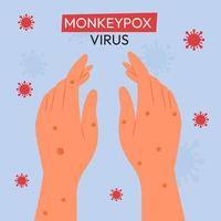 Monkeypox outbreak. Monkeypox are shown on the patient's hand. Flat vector illustration for informing people about an infectious disease.