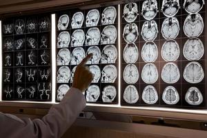 médico apuntando a la resonancia magnética del cerebro humano foto