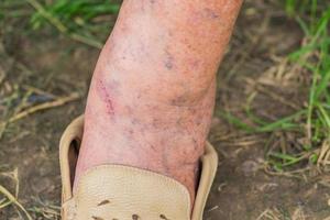 injured leg of elderly woman with varicose veins. photo