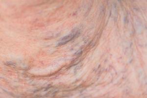 close up of varicose veins on female leg photo