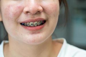 Braces in teenage girl mouth to treat and beauty for increase confidence and good personality. photo